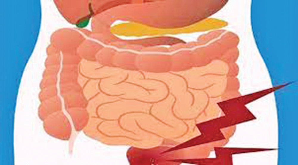 পাইলস চিকিৎসায় রিং লাইগেশন পাইলস চিকিৎসায় রিং লাইগেশন