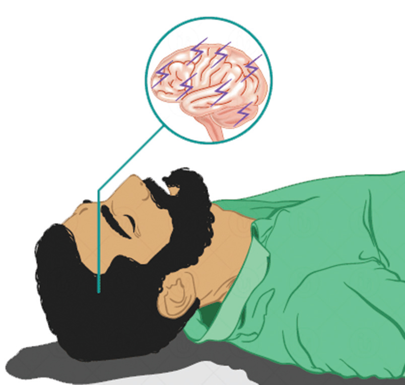 মৃগী রোগের কারণ কী মৃগী রোগের কারণ কী