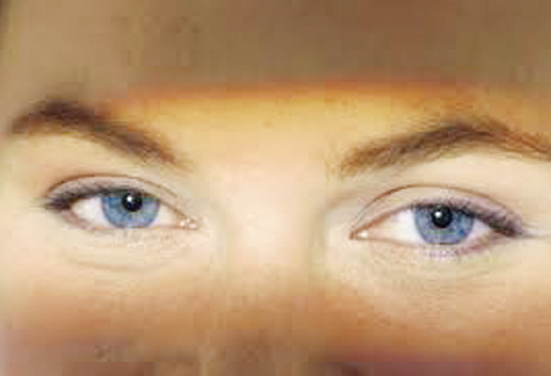 রাতকানা রোগ কী কেন হয়? রাতকানা রোগ কী কেন হয়?