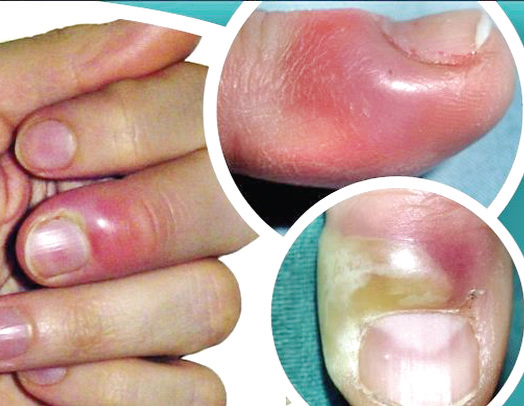 নখের চারপাশে ব্যথা ও ফোলাভাব নখের চারপাশে ব্যথা ও ফোলাভাব