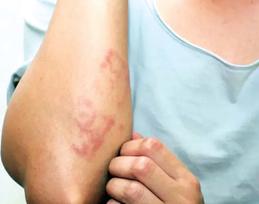 একজিমা দূর করার ঘরোয়া উপায় একজিমা দূর করার ঘরোয়া উপায়