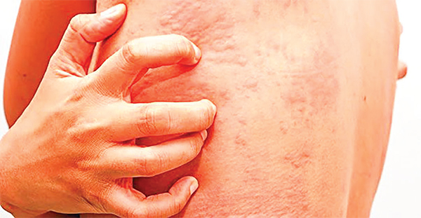 গরমে অ্যালার্জিজনিত রোগ ও চিকিৎসা গরমে অ্যালার্জিজনিত রোগ ও চিকিৎসা