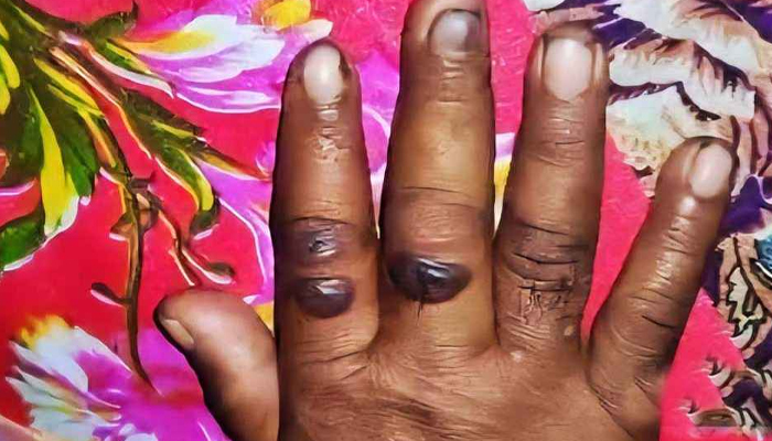 অ্যানথ্রাক্সের উপসর্গ নিয়ে গাইবান্ধায় নারীর মৃত্যু অ্যানথ্রাক্সের উপসর্গ নিয়ে গাইবান্ধায় নারীর মৃত্যু