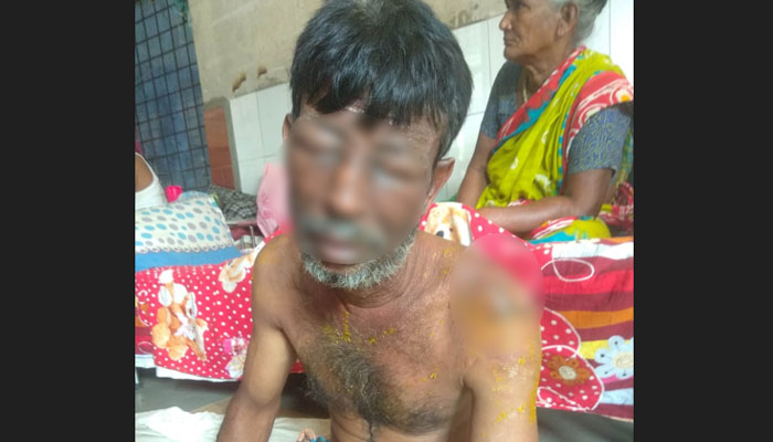 চাঁদপুরে স্ত্রীর গরম পানি নিক্ষেপে ঝলসে গেল স্বামীর মুখ চাঁদপুরে স্ত্রীর গরম পানি নিক্ষেপে ঝলসে গেল স্বামীর মুখ