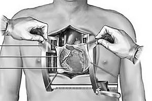 বাংলাদেশে ওপেন হার্ট সার্জারি : চ্যালেঞ্জ ও বাস্তবতা বাংলাদেশে ওপেন হার্ট সার্জারি : চ্যালেঞ্জ ও বাস্তবতা