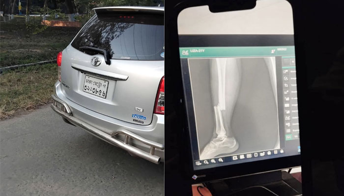 রাবিতে শিক্ষকের প্রাইভেটকারের ধাক্কায় পা ভাঙল ছাত্রীর