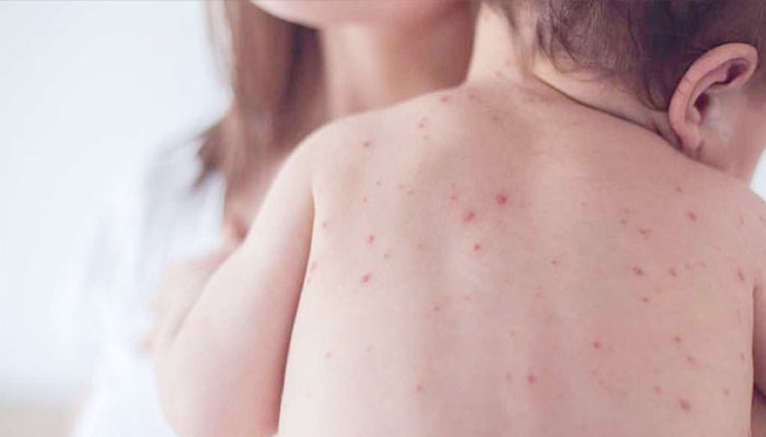 ২৪ ঘণ্টায় হামের উপসর্গে ৭ জনের মৃত্যু, বাড়ছে আক্রান্তের সংখ্যা ২৪ ঘণ্টায় হামের উপসর্গে ৭ জনের মৃত্যু, বাড়ছে আক্রান্তের সংখ্যা