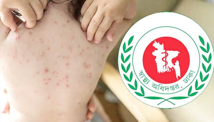 গত একদিনে আরও ৭ শিশুর মৃত্যু, বাড়ছে হাম সংক্রমণ গত একদিনে আরও ৭ শিশুর মৃত্যু, বাড়ছে হাম সংক্রমণ