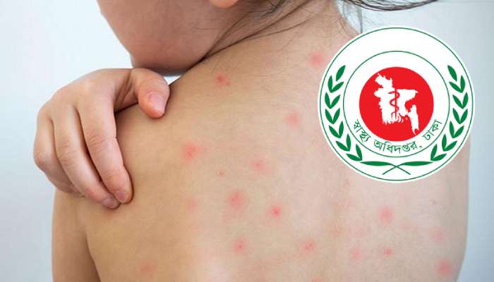 হাম ও হামের উপসর্গে আরও ৭ শিশুর মৃত্যু হাম ও হামের উপসর্গে আরও ৭ শিশুর মৃত্যু