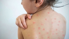 হাম হলে যা করা উচিত