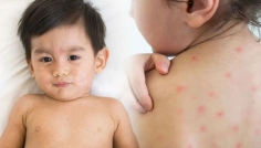 ২৪ ঘণ্টায় সন্দেহজনক হামে আক্রান্ত ৯৪৭, মৃত্যু ৩