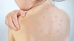 হাম কীভাবে ছড়ায়  