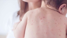 ২৪ ঘণ্টায় হামের উপসর্গে ৭ জনের মৃত্যু, বাড়ছে আক্রান্তের সংখ্যা