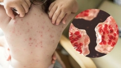 রাজশাহীতে হামের উপসর্গ নিয়ে আরও ৩ শিশুর মৃত্যু