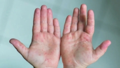 চট্টগ্রামে একদিনে ৪ শিশুর দেহে হাম শনাক্ত