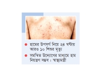 হাম ও উপসর্গ নিয়ে ১৭৪ জনের মৃত্যু  