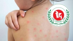 হাম ও হামের উপসর্গে আরও ৮ শিশুর মৃত্যু