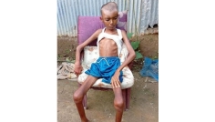 দুর্গাপুরে বিরল রোগে আক্রান্ত কিশোর, সহায়তা চান পরিবার