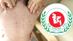 ২৪ ঘণ্টায় হামের উপসর্গে আরও ৯ শিশুর মৃত্যু