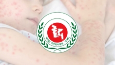 ২৪ ঘণ্টায় হামের উপসর্গে আরও ৪ শিশুর মৃত্যু