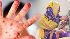 ২৪ ঘণ্টায় হাম ও উপসর্গে আরও ৮ জনের মৃত্যু